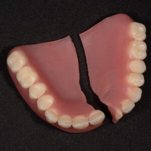 Broken acrylic upper single denture